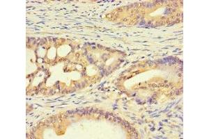Immunohistochemistry of paraffin-embedded human colon cancer using ABIN7174792 at dilution of 1:100 (C1ORF53 antibody  (AA 1-145))