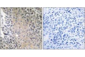 Immunohistochemistry analysis of paraffin-embedded human lung carcinoma, using RAB41 Antibody. (RAB41 antibody  (AA 115-164))