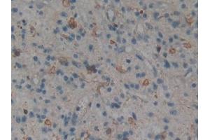 Detection of MAPK11 in Human Glioma Tissue using Polyclonal Antibody to Mitogen Activated Protein Kinase 11 (MAPK11) (MAPK11 antibody  (AA 38-277))