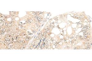 Immunohistochemistry of paraffin-embedded Human gastric cancer tissue using DCP2 Polyclonal Antibody at dilution of 1:45(x200) (DCP2 antibody)