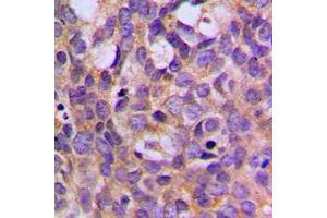 Immunohistochemical analysis of S6K1 (pT444) staining in human breast cancer formalin fixed paraffin embedded tissue section.