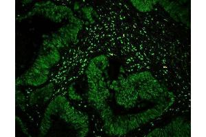 IF analysis of CTBP1 using anti-CTBP1 antibody (ABIN3043816) CTBP1 was detected in paraffin-embedded section of human intestinal cancer tissues.