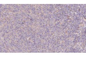 ABIN6273077 at 1/100 staining Human lymph cancer tissue by IHC-P. (SRP9 antibody  (Internal Region))