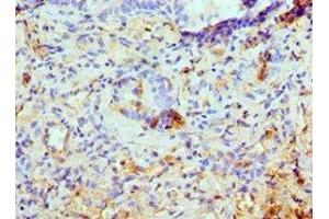 Immunohistochemistry of paraffin-embedded human lung cancer using ABIN7145103 at dilution of 1:100 (ATG13 antibody  (AA 318-517))