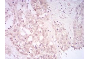 Immunohistochemical analysis of paraffin-embedded liver cancer tissues using SIRT7 mouse mAb with DAB staining.