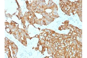 Formalin-fixed, paraffin-embedded human Colon Carcinoma stained with CK19 Mouse Recombinant Monoclonal Antibody (rKRT19/800). (Recombinant Cytokeratin 19 antibody)
