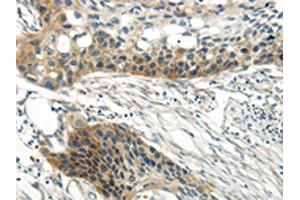 The image on the left is immunohistochemistry of paraffin-embedded Human esophagus cancer tissue using ABIN7193067(WNT6 Antibody) at dilution 1/35, on the right is treated with synthetic peptide. (WNT6 antibody)