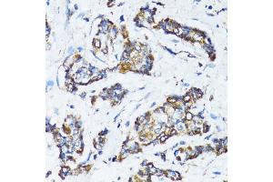 Immunohistochemistry of paraffin-embedded human breast cancer using ATG7 antibody (ABIN6292614) at dilution of 1:100 (40x lens). (ATG7 antibody)