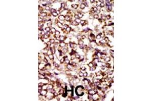 Formalin-fixed and paraffin-embedded human hepatocellular carcinoma tissue reacted with CDK2 polyclonal antibody  , which was peroxidase-conjugated to the secondary antibody, followed by DAB staining. (CDK2 antibody  (C-Term))