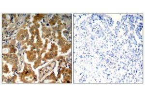Immunohistochemical analysis of paraffin-embedded human lung carcinoma tissue using ADD1(Phospho-Ser726) Antibody(left) or the same antibody preincubated with blocking peptide(right). (alpha Adducin antibody  (pSer726))