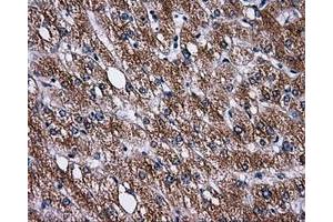 Immunohistochemical staining of paraffin-embedded Carcinoma of liver tissue using anti-PASKmouse monoclonal antibody. (PASK antibody)