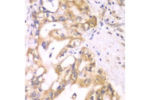 Immunohistochemistry of paraffin-embedded human liver cancer using ACADS antibody. (ACADS antibody  (AA 1-260))
