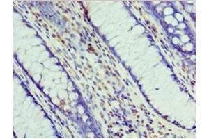 Immunohistochemistry of paraffin-embedded human colon cancer using ABIN7164708 at dilution of 1:100 (Prohibitin 2 antibody  (AA 1-299))