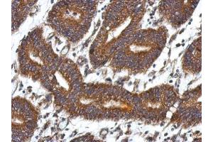 IHC-P Image Immunohistochemical analysis of paraffin-embedded human colon carcinoma, using QDPR, antibody at 1:500 dilution.