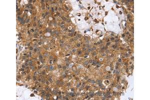 Immunohistochemistry of Human lung cancer using TPM2 Polyclonal Antibody at dilution of 1:35 (TPM2 antibody)