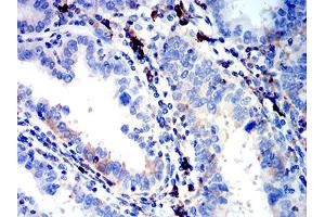 Immunohistochemical analysis of paraffin-embedded endometrial cancer tissues using IGLC2 mouse mAb with DAB staining. (IGLC2 antibody  (AA 1-106))