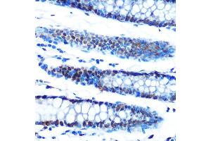 Immunohistochemistry of paraffin-embedded human colon using  Rabbit mAb (ABIN7265458) at dilution of 1:100 (40x lens). (ADAR antibody)