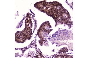 IHC testing of FFPE human colon cancer with p65 antibody at 2ug/ml. (NF-kB p65 antibody  (AA 99-551))