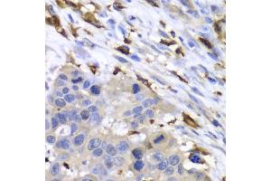 Immunohistochemistry of paraffin-embedded human esophageal cancer using S100A8 antibody at dilution of 1:100 (400x lens). (S100A8 antibody)