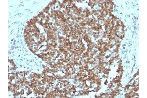 Formalin-fixed, paraffin-embedded human ovarian carcinoma stained with Nucleolin antibody. (Nucleolin antibody)