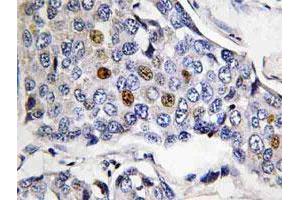 Immunohistochemical analysis of paraffin-embedded human breast cancer tissue using POLR3A polyclonal antibody .