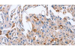 Immunohistochemistry of paraffin-embedded Human lung cancer tissue using NRG4 Polyclonal Antibody at dilution 1:60 (Neuregulin 4 antibody)