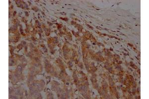 IHC image of ABIN7127624 diluted at 1:100 and staining in paraffin-embedded human breast cancer performed on a Leica BondTM system. (Recombinant MMP12 antibody)