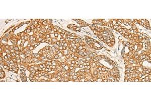Immunohistochemistry of paraffin-embedded Human liver cancer tissue using DARS Polyclonal Antibody at dilution of 1:25(x200)