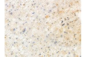 ABIN7096855 and ABIN7100921 at 1/100 staining human astrocytoma by IHC-P. (PAPD1 antibody)
