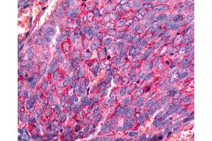 Anti-GALR2 / Galanin Receptor 2 antibody IHC of human Ovary, Carcinoma. (GALR2 antibody  (Transmembrane Domain))