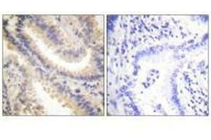 Immunohistochemistry analysis of paraffin-embedded human lung carcinoma tissue using TIMP4 antibody.