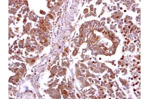 IHC-P Image CCR8 antibody detects CCR8 protein at cytosol and membrane on human hepatoma by immunohistochemical analysis. (CCR8 antibody  (C-Term))