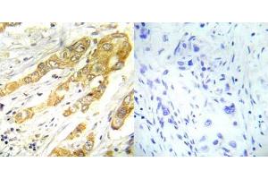 Immunohistochemical analysis of paraffin- embedded human breast carcinoma tissue using ERK1/2 (Thr202/Tyr204) antibody (E022017). (ERK1/2 antibody)
