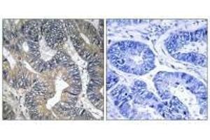 Immunohistochemistry analysis of paraffin-embedded human colon carcinoma tissue using GTPBP2 antibody. (GTPBP2 antibody)