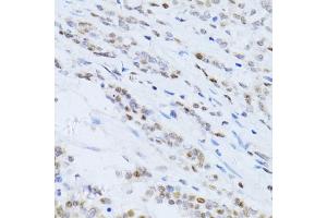 Immunohistochemistry of paraffin-embedded human colon carcinoma using CDKN1A antibody (ABIN5995726) at dilution of 1/100 (40x lens). (p21 antibody)