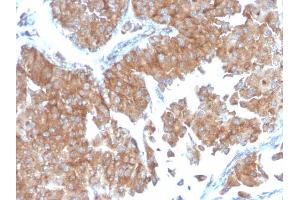 Formalin-fixed, paraffin-embedded human Urothelial Carcinoma stained with PAI-RBP1 Mouse Monoclonal Antibody (SERBP1/3498). (SERBP1 antibody  (AA 3-139))