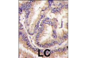 Formalin-fixed and paraffin-embedded human lung carcinoma tissue reacted with STK9 Antibody , which was peroxidase-conjugated to the secondary antibody, followed by DAB staining. (CDKL5 antibody  (C-Term))