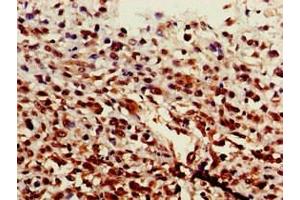 Immunohistochemistry of paraffin-embedded human melanoma using ABIN7143911 at dilution of 1:100 (ST6GALNAC1 antibody  (AA 36-249))