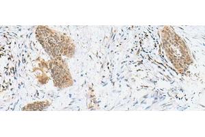 Immunohistochemistry of paraffin-embedded Human esophagus cancer tissue using LPXN Polyclonal Antibody at dilution of 1:60(x200) (Leupaxin antibody)