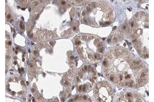 ABIN6267701 at 1/100 staining human kindey carcinoma tissue sections by IHC-P. (CaMK2 alpha/beta/delta antibody  (pThr305))