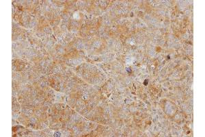 IHC-P Image Immunohistochemical analysis of paraffin-embedded SW480 xenograft, using CHI3L2, antibody at 1:500 dilution. (CHI3L2 antibody)