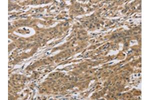 The image on the left is immunohistochemistry of paraffin-embedded Human gastric cancer tissue using ABIN7129118(CYFIP2 Antibody) at dilution 1/25, on the right is treated with fusion protein. (CYFIP2 antibody)