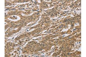 The image on the left is immunohistochemistry of paraffin-embedded Human gastric cancer tissue using ABIN7129118(CYFIP2 Antibody) at dilution 1/25, on the right is treated with fusion protein. (CYFIP2 antibody)