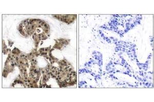 Immunohistochemical analysis of paraffin-embedded human breast carcinoma tissue using 4E-BP1 (Ab-45) antibody (E021216). (eIF4EBP1 antibody)