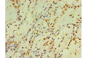 Immunohistochemistry of paraffin-embedded human breast cancer using ABIN7149253 at dilution of 1:100 (CYP2J2 antibody  (AA 328-502))