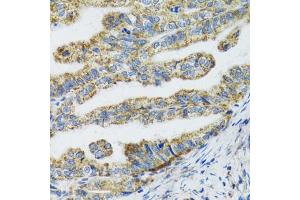 Immunohistochemistry of paraffin-embedded human gastric cancer using TXN2 antibody (ABIN2560616) at dilution of 1:100 (40x lens). (TXN2 antibody)