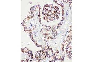 Anti-Peroxiredoxin 5 antibody, IHC(P) IHC(P): Human Prostatic Cancer Tissue