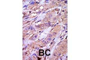 Formalin-fixed and paraffin-embedded human cancer tissue reacted with the primary antibody, which was peroxidase-conjugated to the secondary antibody, followed by DAB staining. (CK1 epsilon antibody  (C-Term))