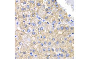Immunohistochemistry of paraffin-embedded human liver cancer using CRK antibody. (Crk antibody)