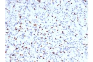 Formalin-fixed, paraffin-embedded human Rhabdomyosarcoma stained with Myogenin Mouse Monoclonal Antibody (MYOG/2660)
